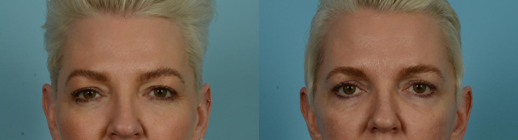 Before & After Fat Grafting by Dr. Mustoe Case 1047 Front View in Chicago, IL