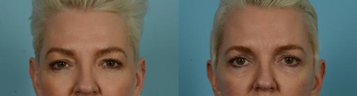 Before & After Fat Grafting by Dr. Mustoe Case 1047 Front View in Chicago, IL