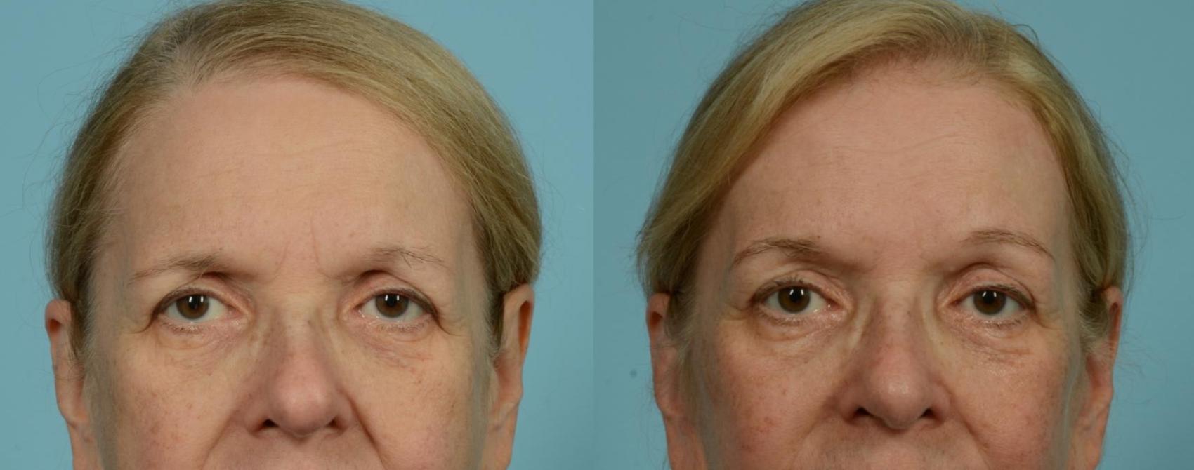 Before & After Blepharoplasty by Dr. Mustoe Case 1058 Front View in Chicago, IL