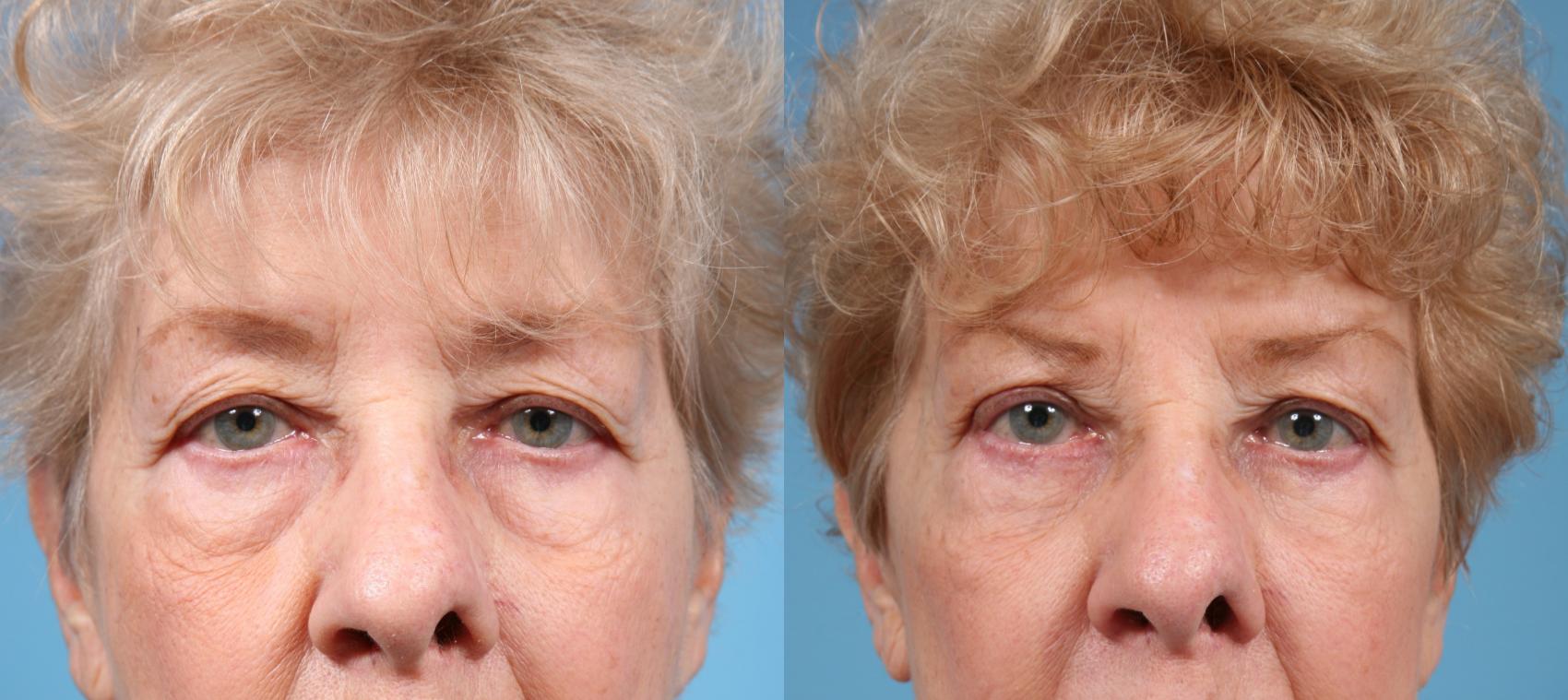 Before & After Blepharoplasty by Dr. Mustoe Case 1060 Front View in Chicago, IL