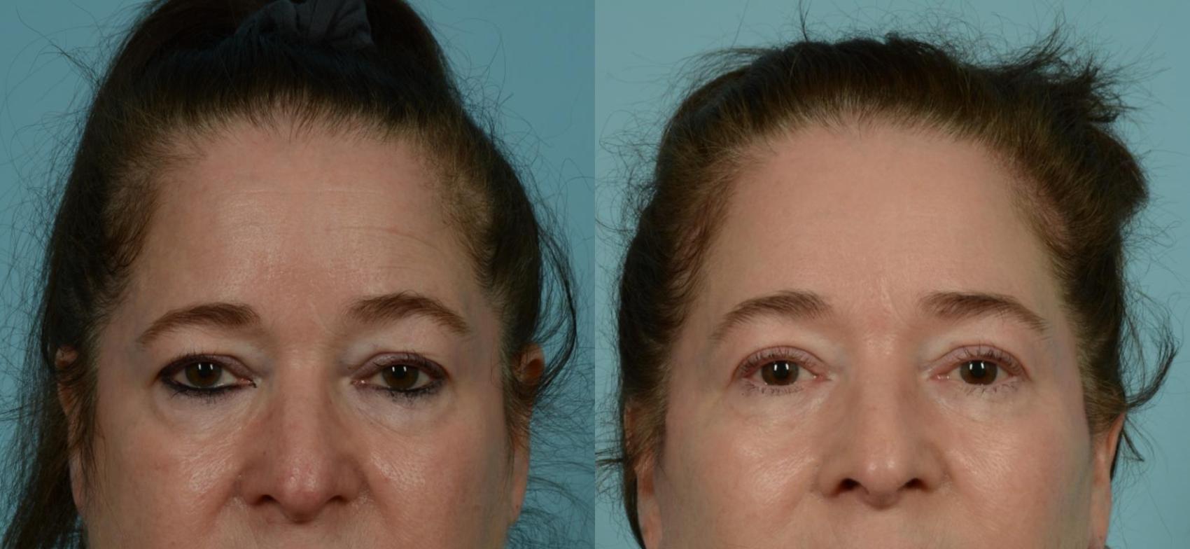 Before & After Blepharoplasty by Dr. Mustoe Case 1063 Front View in Chicago, IL
