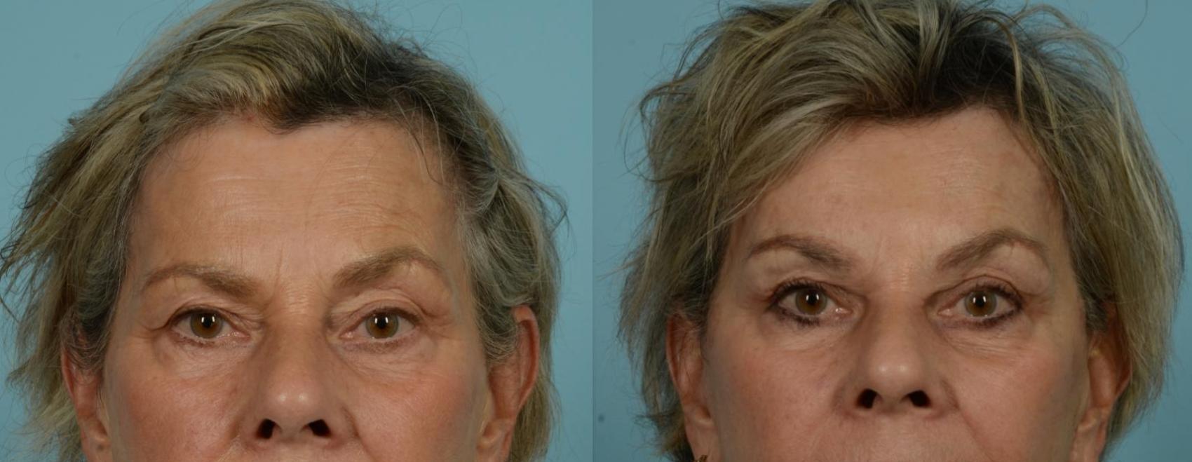 Before & After Blepharoplasty by Dr. Mustoe Case 1064 Front View in Chicago, IL