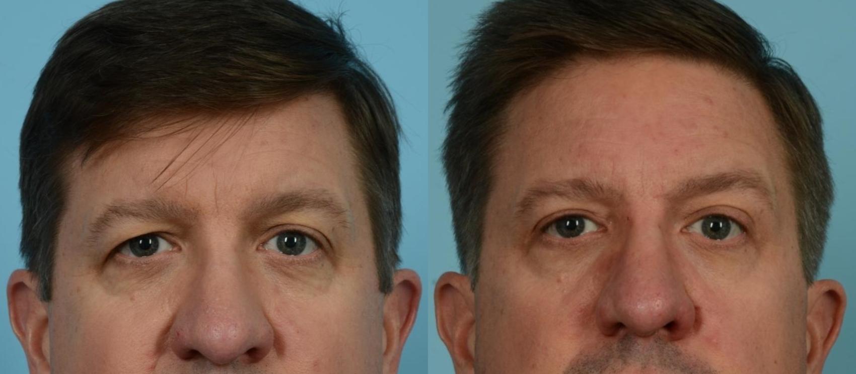 Before & After Blepharoplasty by Dr. Mustoe Case 1066 Front View in Chicago, IL