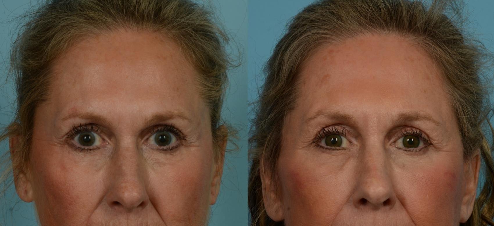 Before & After Blepharoplasty by Dr. Mustoe Case 1068 Front View in Chicago, IL