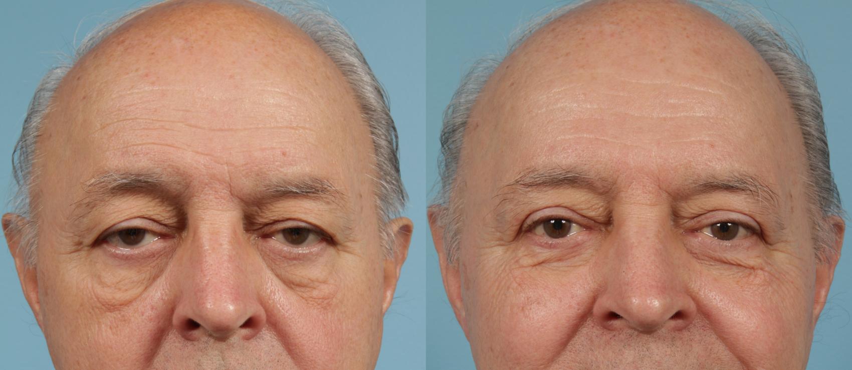 Before & After Blepharoplasty by Dr. Mustoe Case 134 Front View in Chicago, IL