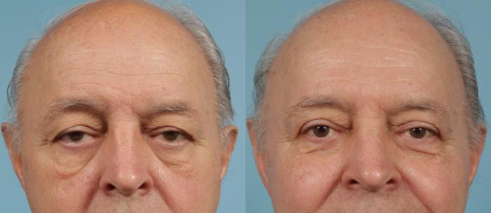 Before & After Blepharoplasty by Dr. Mustoe Case 134 Front View in Chicago, IL