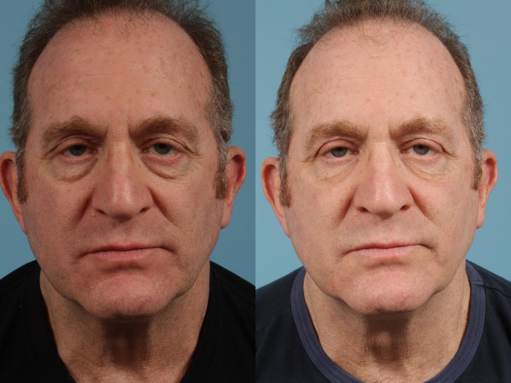 Before & After Blepharoplasty by Dr. Mustoe Case 137 View #2 View in Chicago, IL