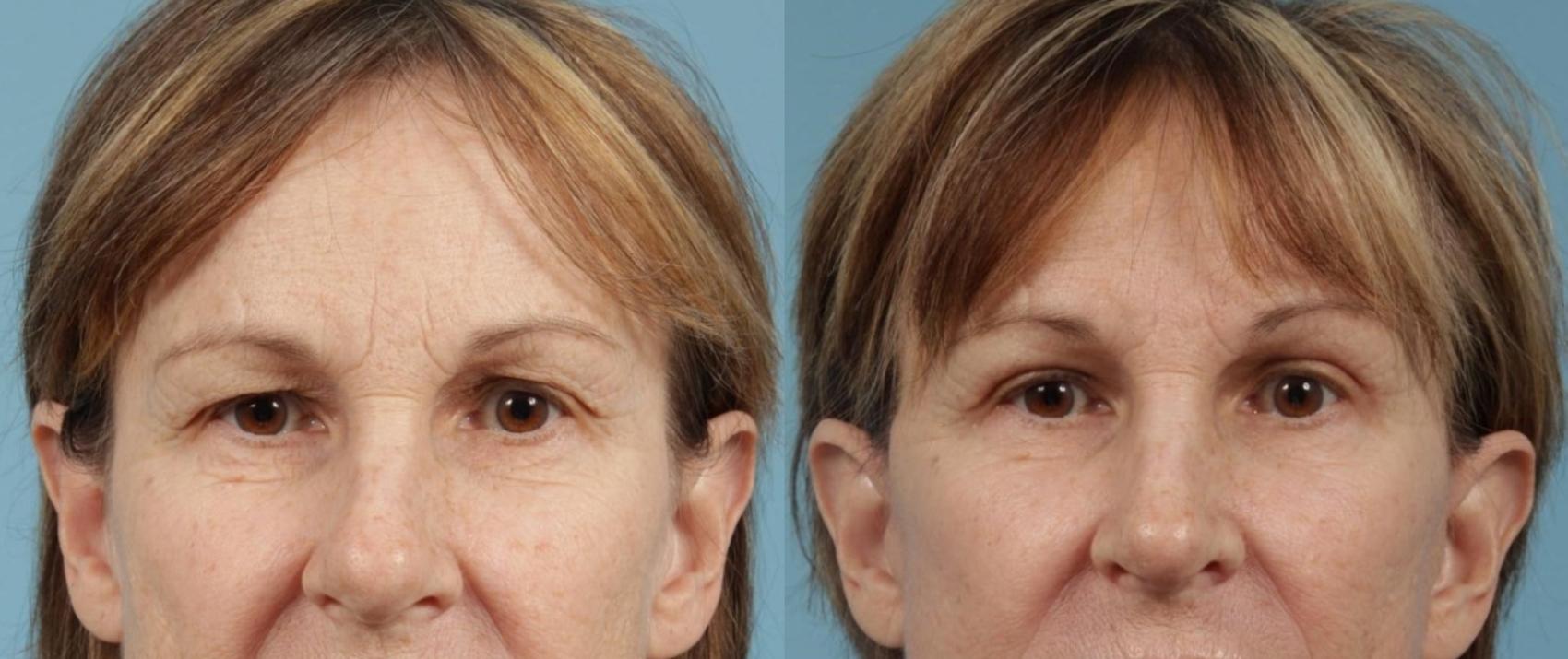 Before & After Blepharoplasty by Dr. Mustoe Case 152 Front View in Chicago, IL