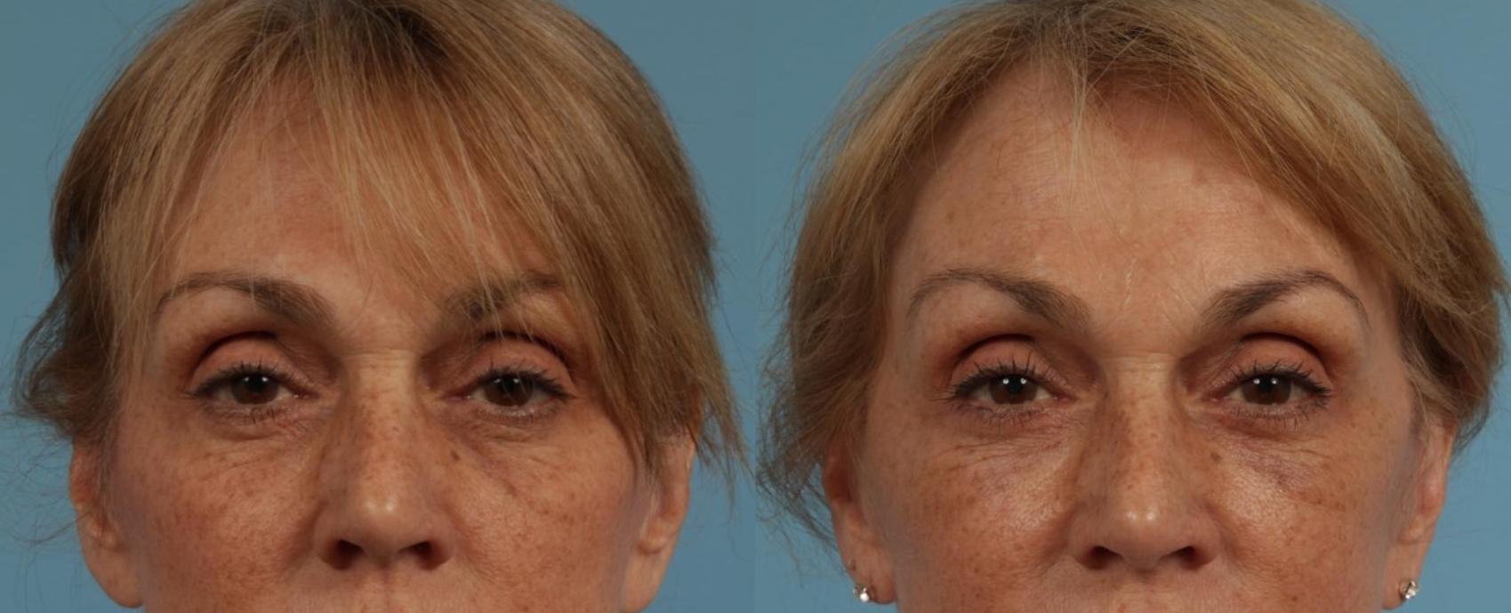 Before & After Blepharoplasty by Dr. Mustoe Case 281 Front View in Chicago, IL