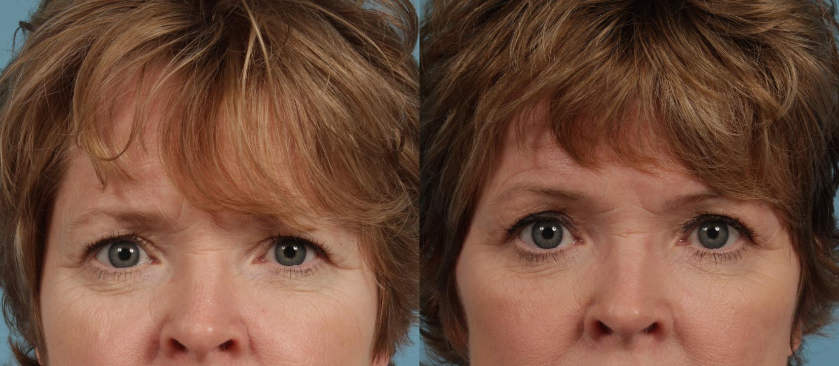 Before & After Blepharoplasty by Dr. Mustoe Case 286 Front View in Chicago, IL
