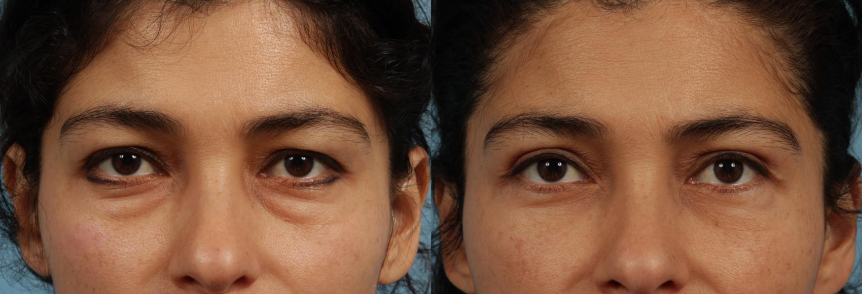Before & After Blepharoplasty by Dr. Mustoe Case 319 Front View in Chicago, IL