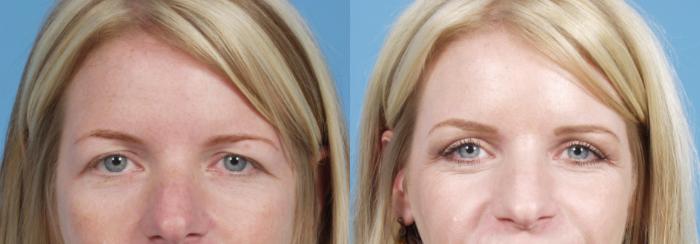 Before & After Blepharoplasty by Dr. Mustoe Case 62 Front View in Chicago, IL