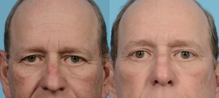Before & After Blepharoplasty by Dr. Mustoe Case 950 Front View in Chicago, IL