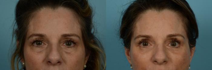 Before & After Brow Lift by Dr. Sinno Case 1096 Front View in Chicago, IL