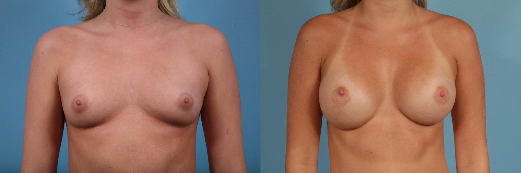 Breast Augmentation Case 47 Before & After View #1 | Chicago, IL | TLKM Plastic Surgery