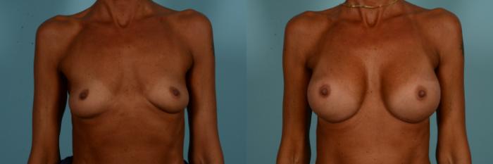 Before & After Breast Augmentation Case 894 Front View in Chicago, IL
