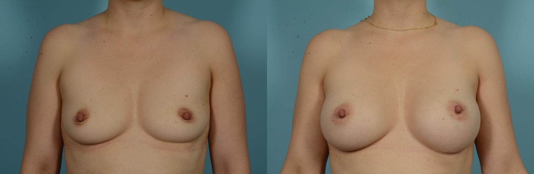 Before & After Breast Augmentation by Dr. Mustoe Case 1013 Front View in Chicago, IL