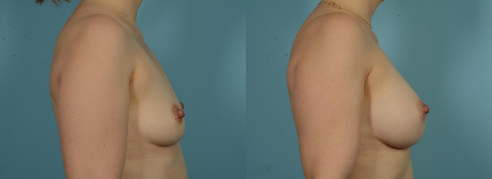 Before & After Breast Augmentation by Dr. Mustoe Case 1013 Right Side View in Chicago, IL