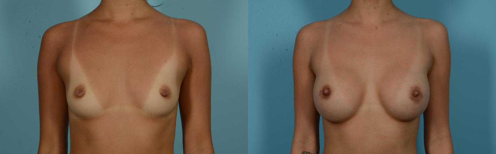 Before & After Breast Augmentation by Dr. Mustoe Case 1053 Front View in Chicago, IL