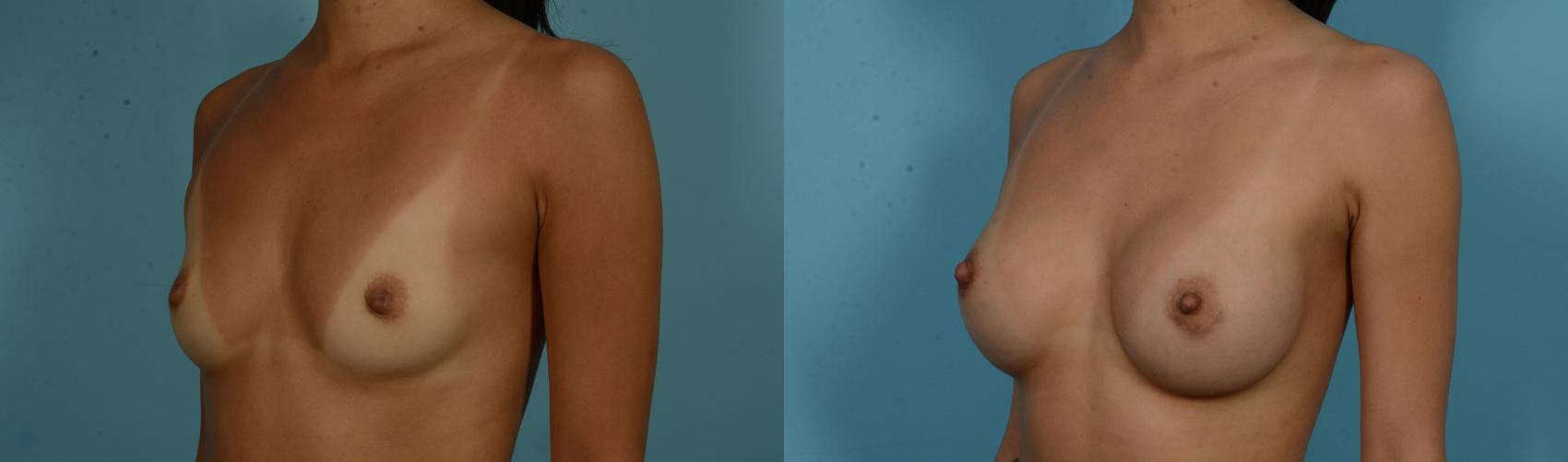 Before & After Breast Augmentation by Dr. Mustoe Case 1053 Left Oblique View in Chicago, IL