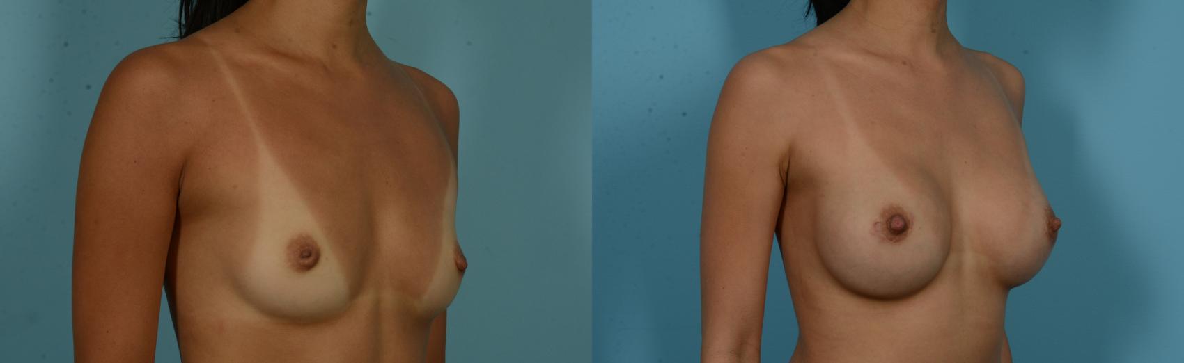 Before & After Breast Augmentation by Dr. Mustoe Case 1053 Right Oblique View in Chicago, IL