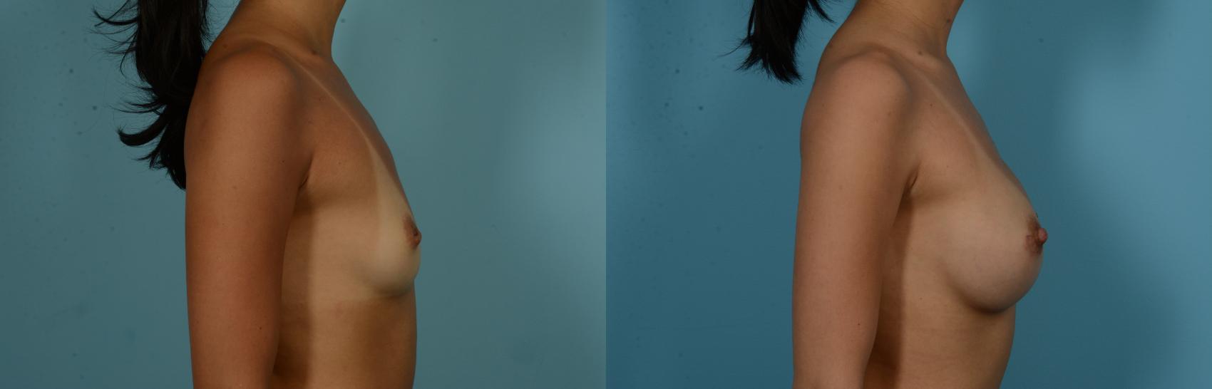 Before & After Breast Augmentation by Dr. Mustoe Case 1053 Right Side View in Chicago, IL