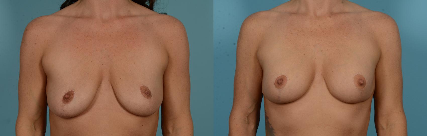 Before & After Breast Augmentation by Dr. Mustoe Case 1091 Front View in Chicago, IL