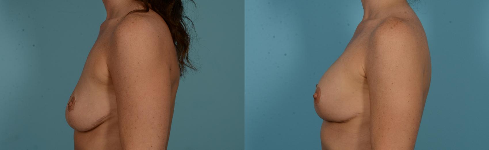 Before & After Breast Augmentation by Dr. Mustoe Case 1091 Left Side View in Chicago, IL
