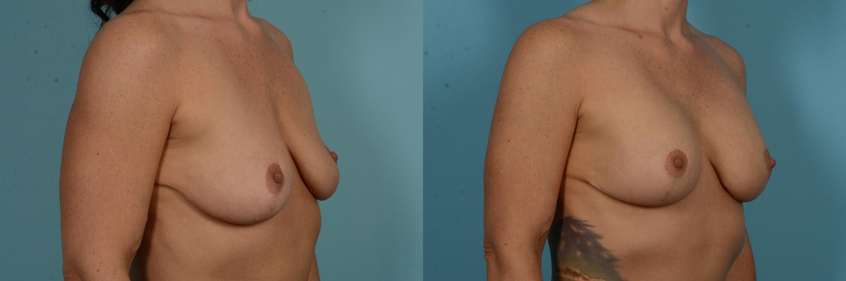 Before & After Breast Augmentation by Dr. Mustoe Case 1091 Right Oblique View in Chicago, IL