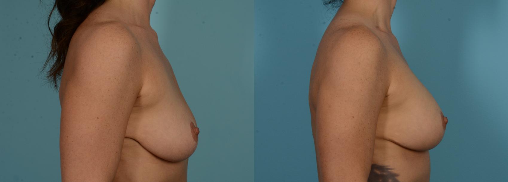 Before & After Breast Augmentation by Dr. Mustoe Case 1091 Right Side View in Chicago, IL