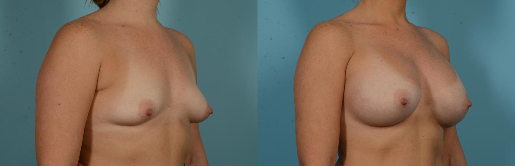 Before & After Breast Augmentation by Dr. Mustoe Case 1103 Right Oblique View in Chicago, IL