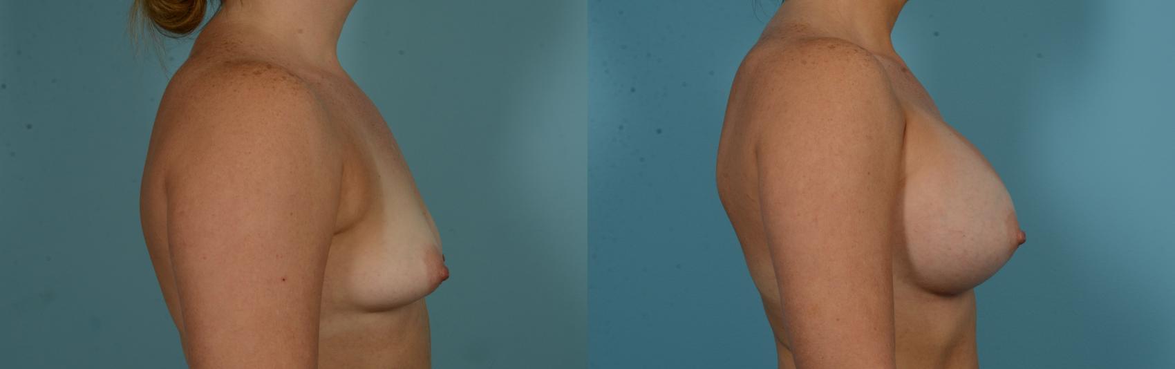 Before & After Breast Augmentation by Dr. Mustoe Case 1103 Right Side View in Chicago, IL
