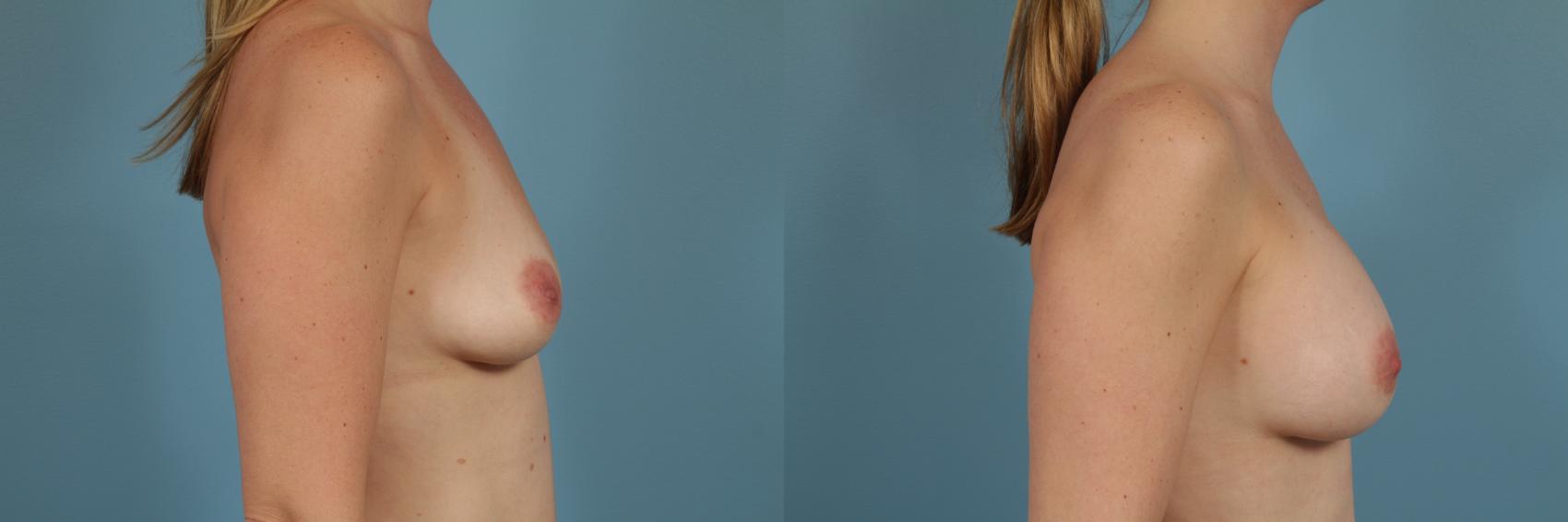 Before & After Breast Augmentation by Dr. Mustoe Case 204 View #3 View in Chicago, IL