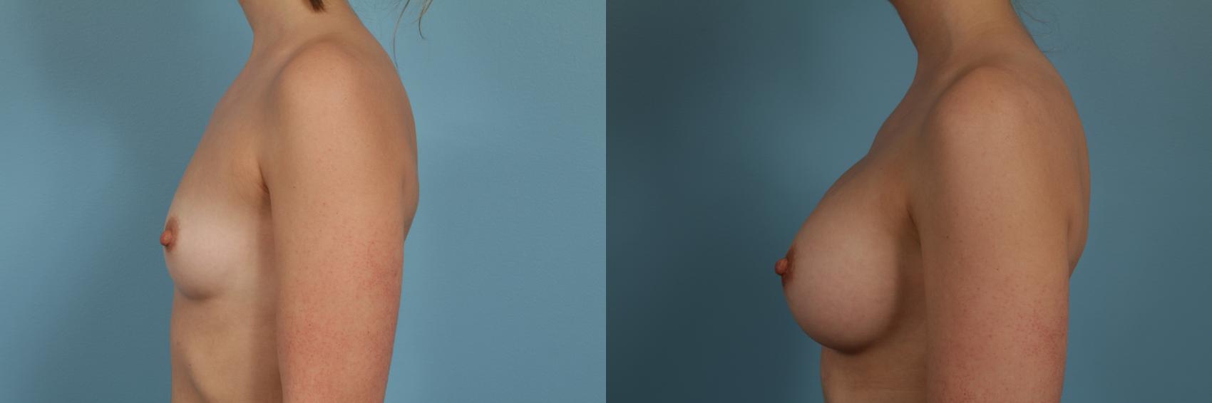 Before & After Breast Augmentation by Dr. Mustoe Case 273 View #2 View in Chicago, IL