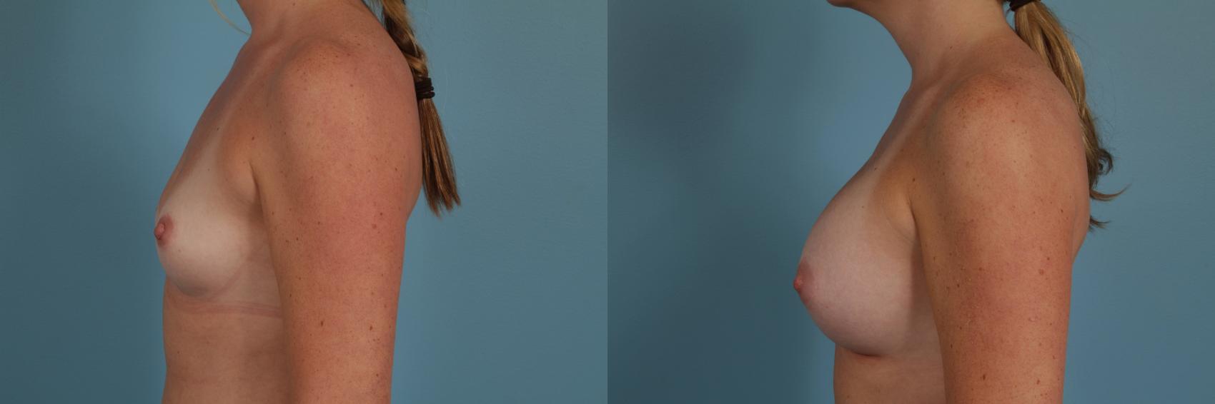 Before & After Breast Augmentation by Dr. Mustoe Case 277 View #2 View in Chicago, IL