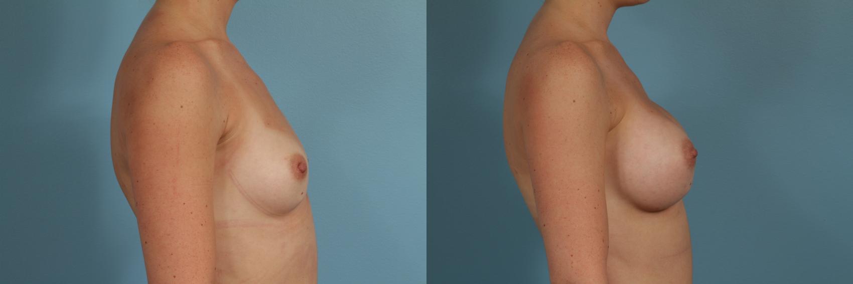 Before & After Breast Augmentation by Dr. Mustoe Case 300 View #3 View in Chicago, IL