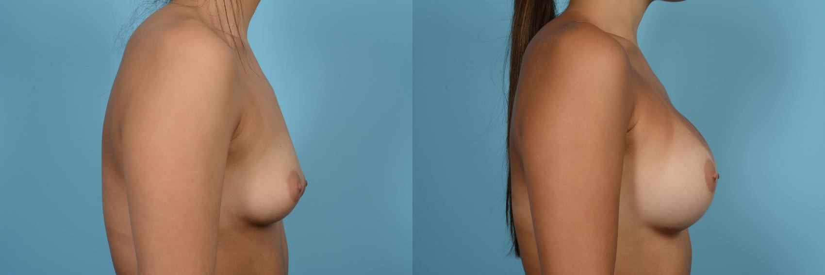 Before & After Breast Augmentation by Dr. Mustoe Case 541 View #3 View in Chicago, IL