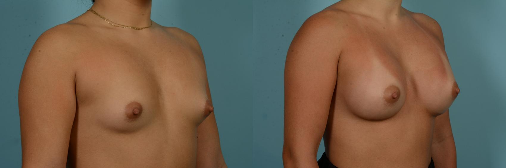 Before & After Breast Augmentation by Dr. Mustoe Case 980 Right Oblique View in Chicago, IL