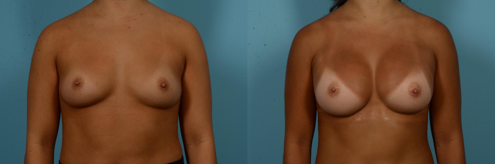 Before & After Breast Augmentation by Dr. Sinno Case 1094 Front View in Chicago, IL