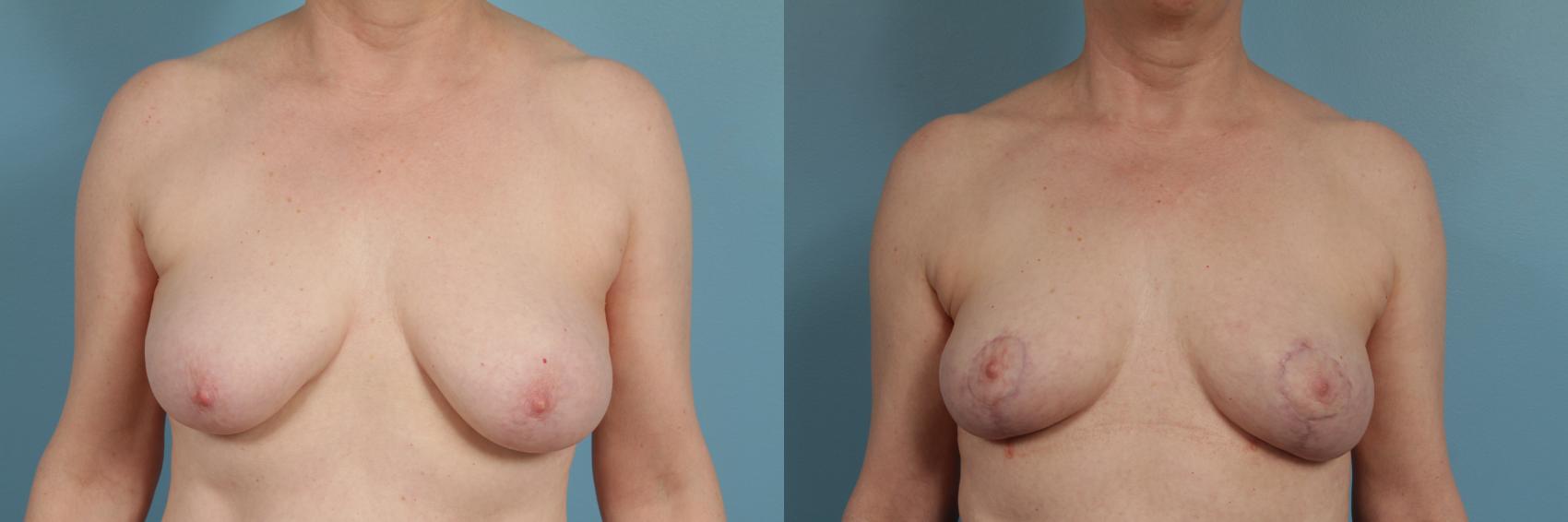 Before & After Breast Lift Case 313 View #1 View in Chicago, IL