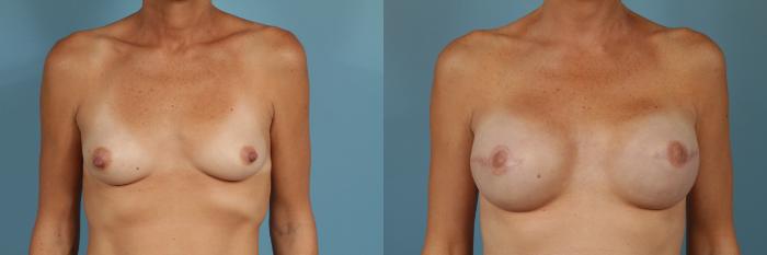 Before & After Breast Reconstruction Case 188 View #1 View in Chicago, IL