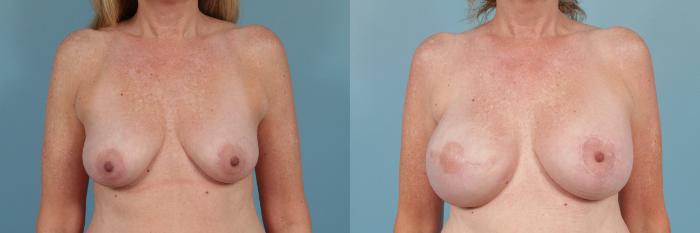 Before & After Breast Reconstruction Case 249 View #1 View in Chicago, IL