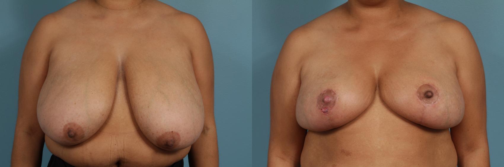 Before & After Breast Reduction Case 302 View #1 View in Chicago, IL