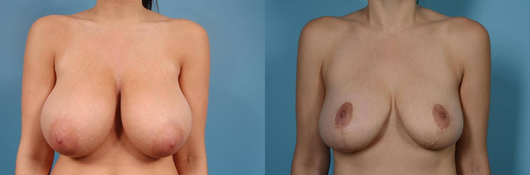 Before & After Breast Reduction Case 82 View #1 View in Chicago, IL