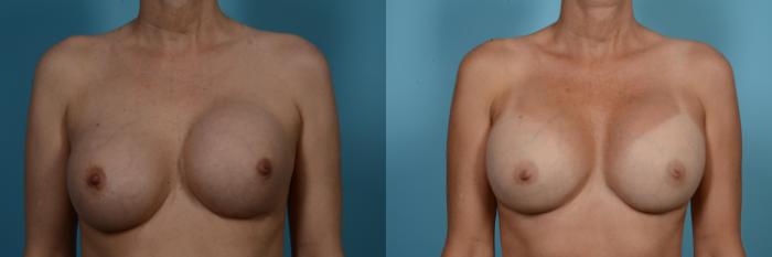 Before & After Breast Revision Surgery Case 556 View #1 View in Chicago, IL