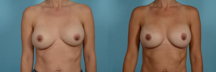 Dr. Sinno Breast Revision Surgery in Chicago, Illinois