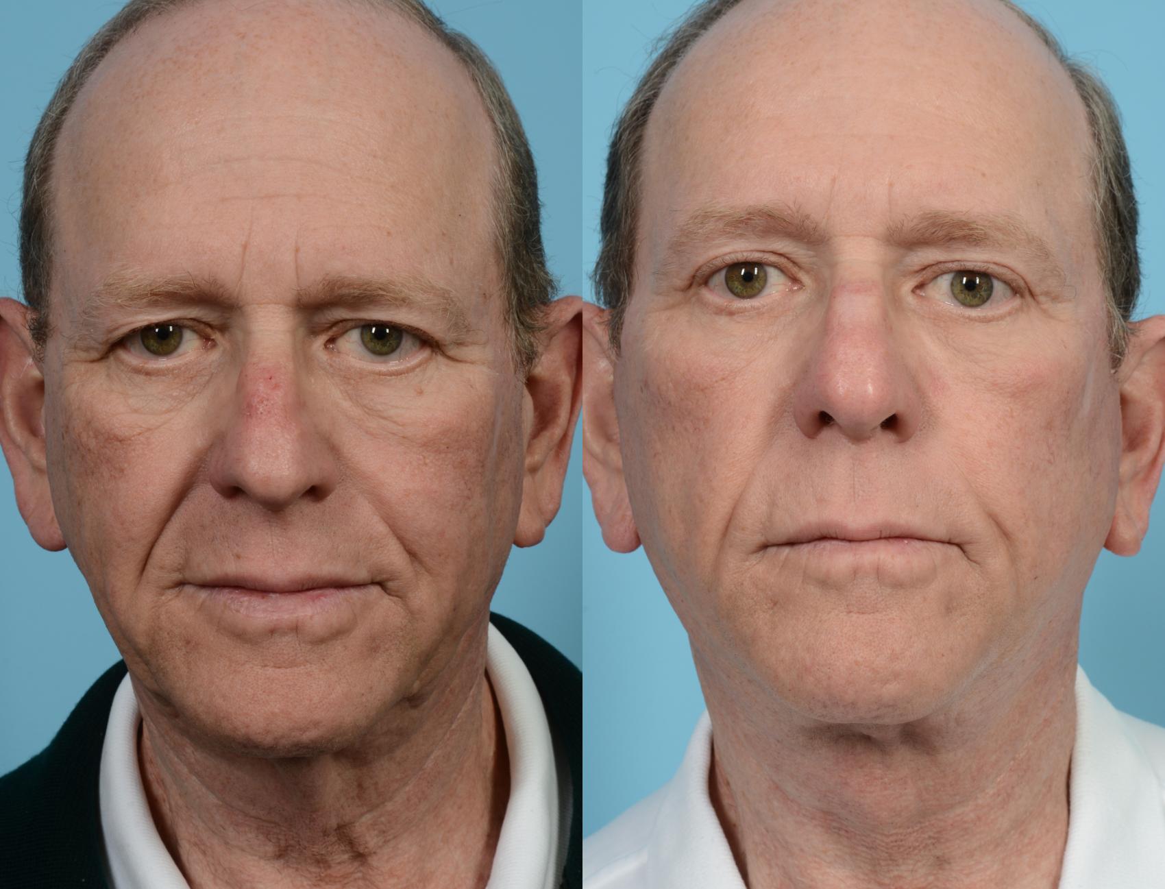 Before & After Brow Lift by Dr. Mustoe Case 1073 Front View in Chicago, IL