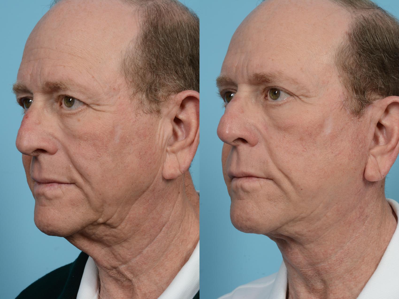 Before & After Brow Lift by Dr. Mustoe Case 1073 Left Oblique View in Chicago, IL