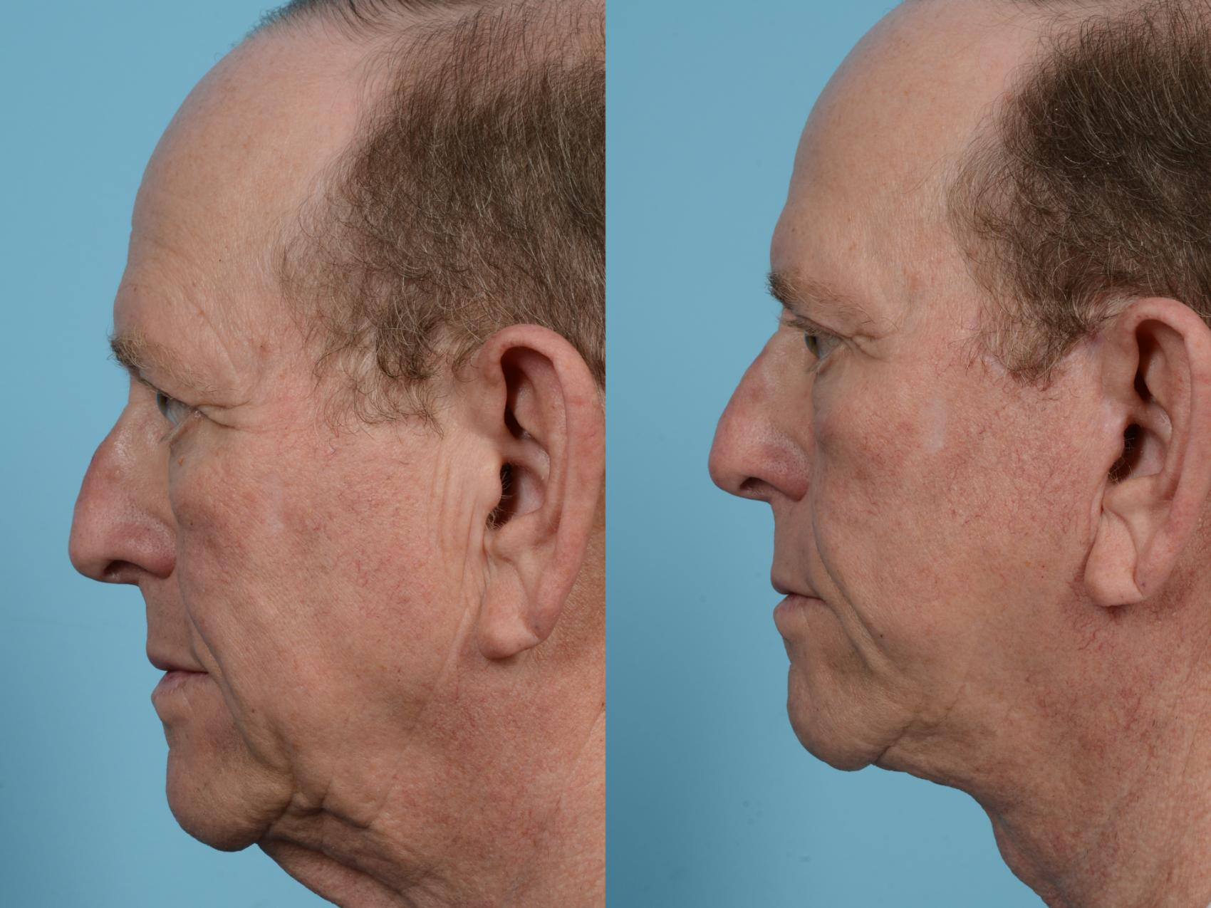 Before & After Brow Lift by Dr. Mustoe Case 1073 Left Side View in Chicago, IL