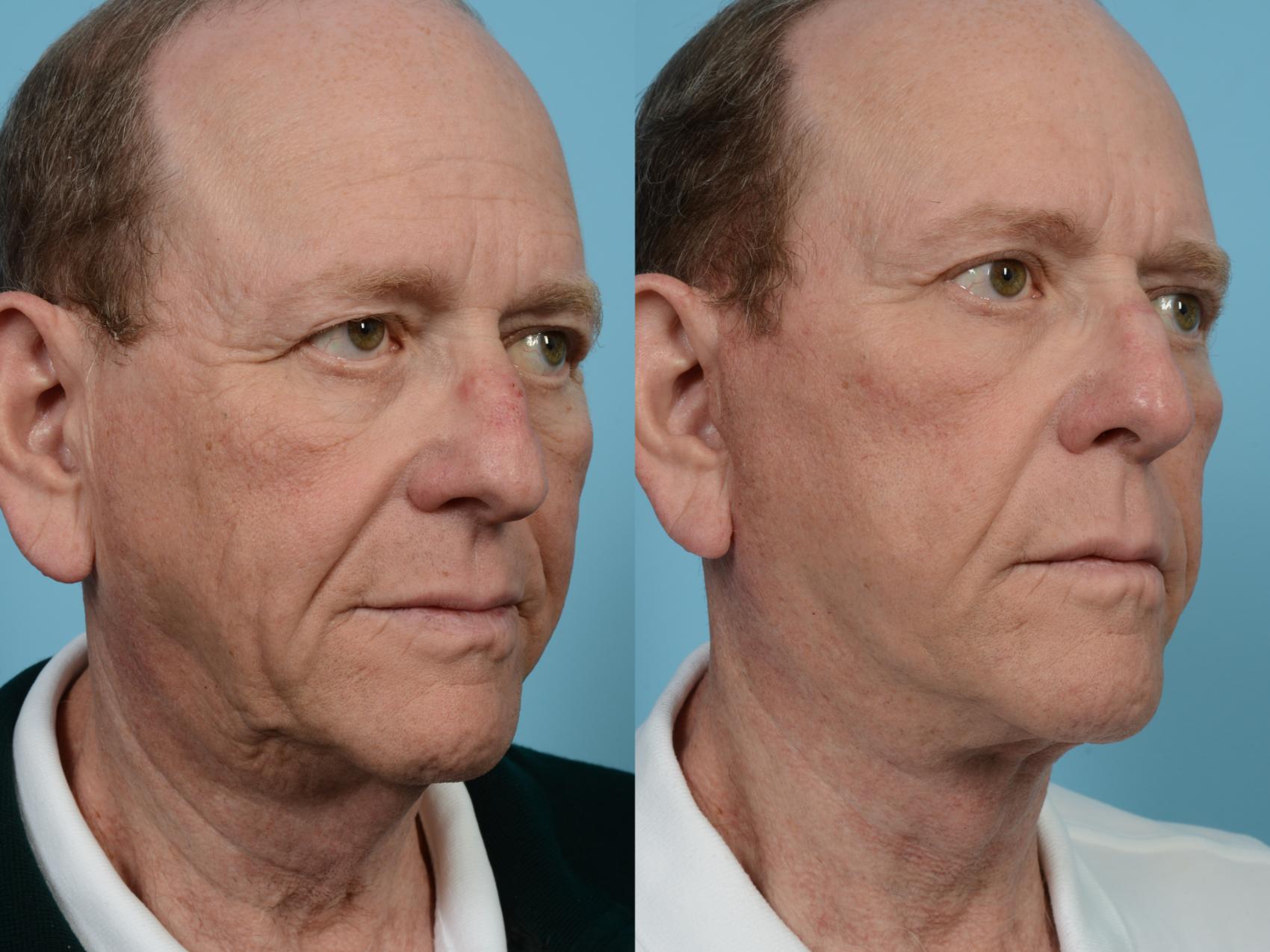 Before & After Brow Lift by Dr. Mustoe Case 1073 Right Oblique View in Chicago, IL